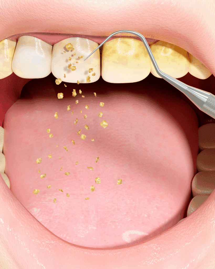 Placa Bacteriana nos dentes