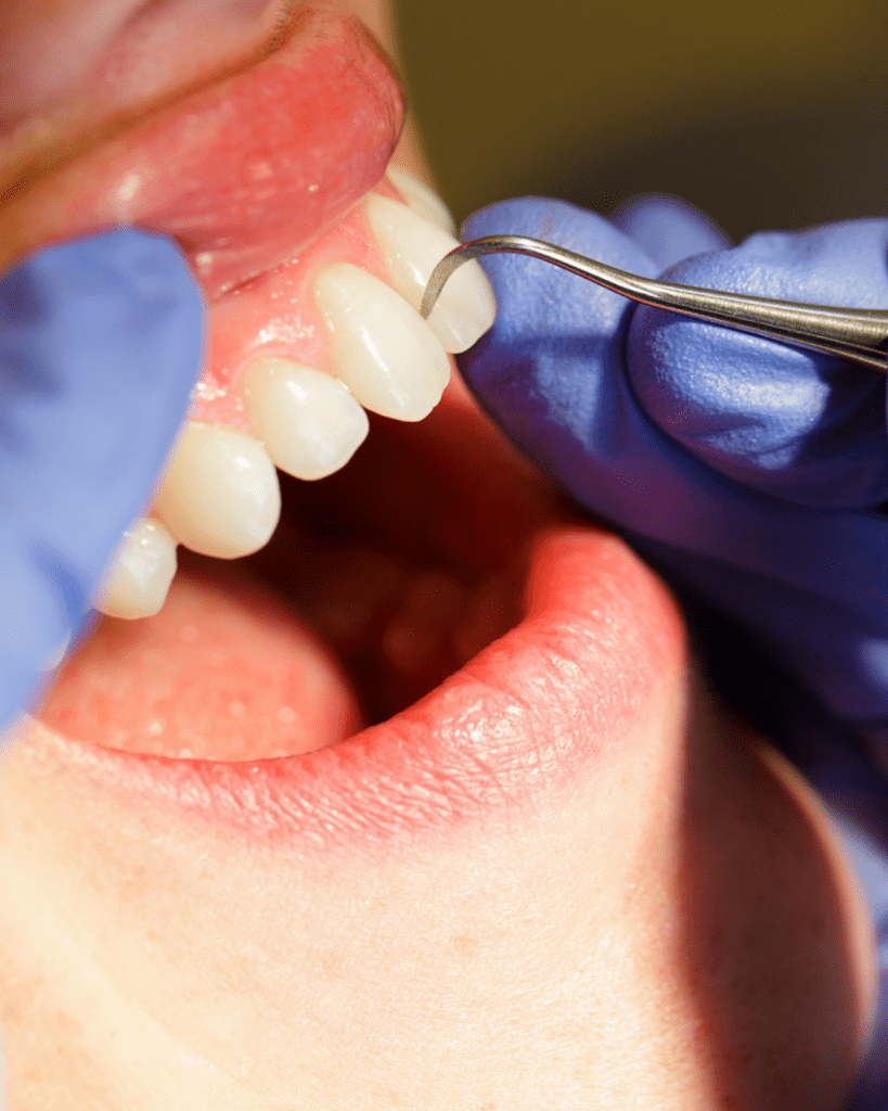 tártaro nos dentes