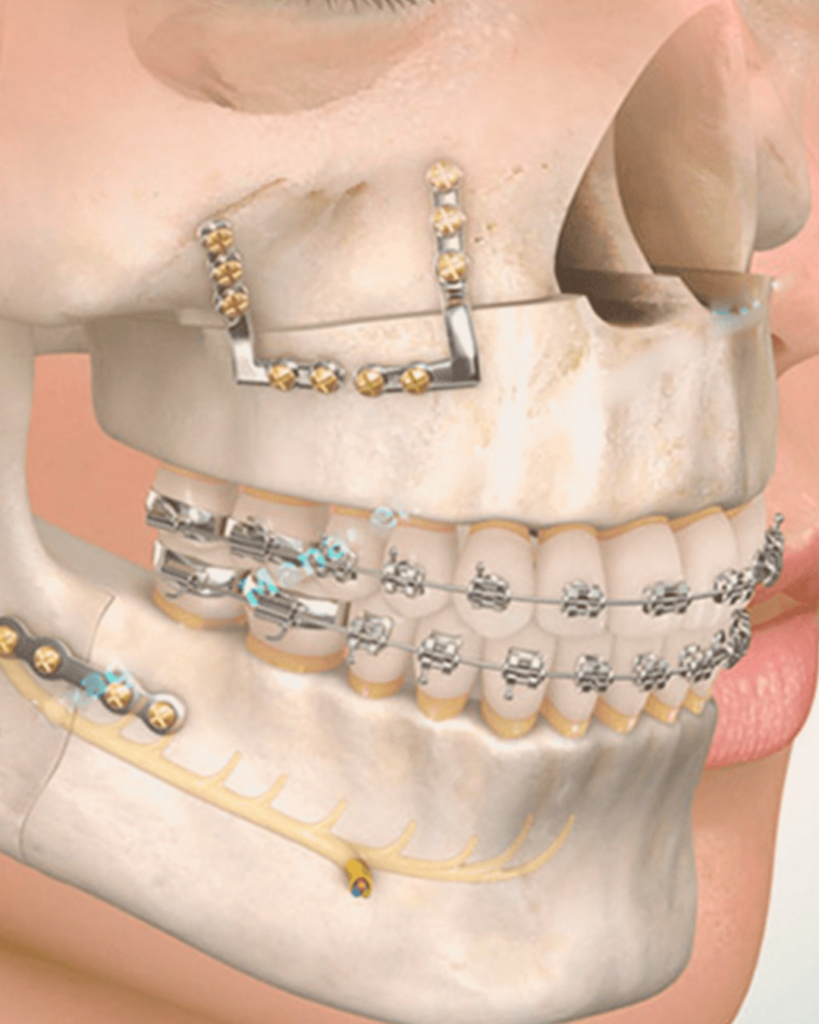 cirurgia ortognática estética