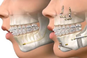 cirurgia ortognática para correção