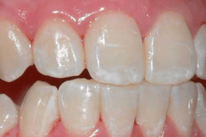 Fluorose Dentária