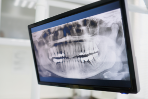 Radiografia Panorâmica