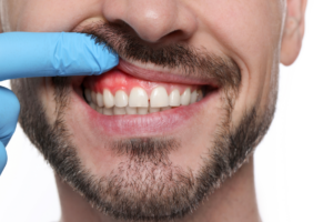 abscesso dentário