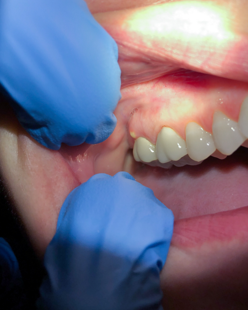 abscesso dentário