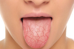 5 causas da xerostomia e como aliviar a boca seca
