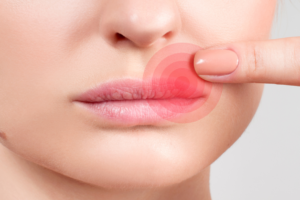 herpes labial