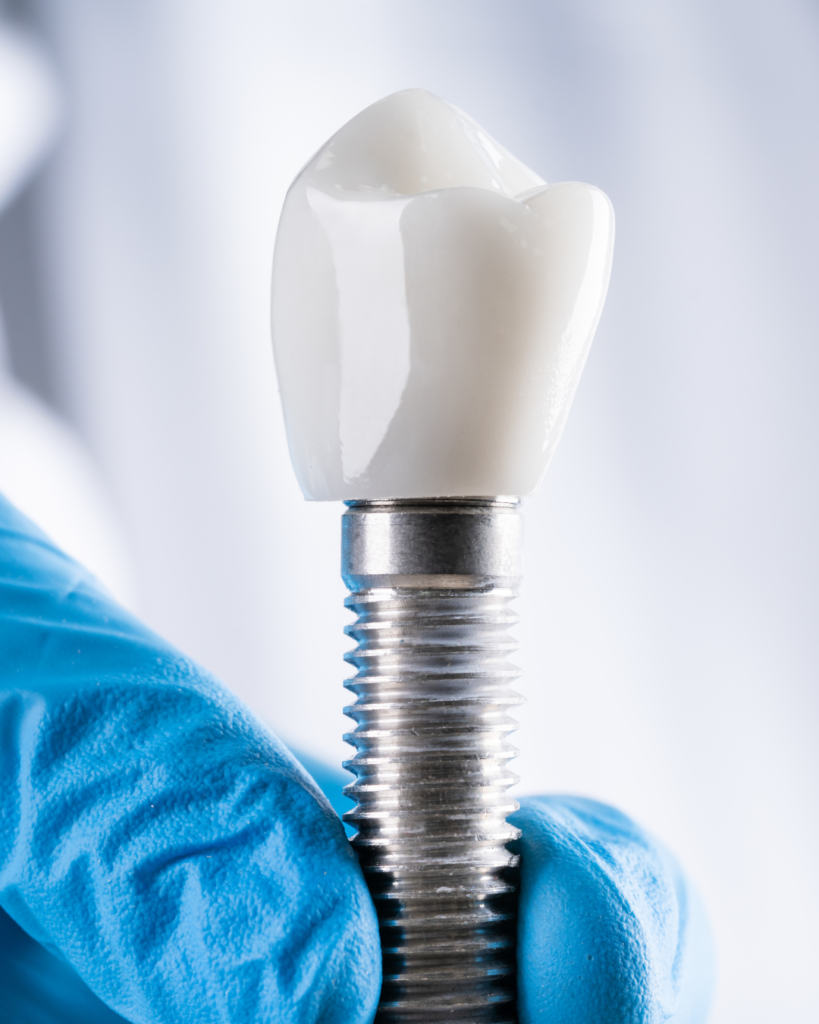 Como é o implante dentário